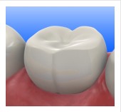 composite-fillings