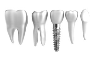 Northside Chicago Implant Dentistry