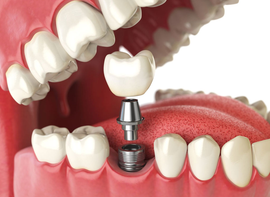 Dental Implants